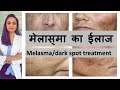 काले दाग का ईलाज | Melasma/ dark spots | pigmentation| Causes & Treatment| Hindi | Dr. Aanchal Panth