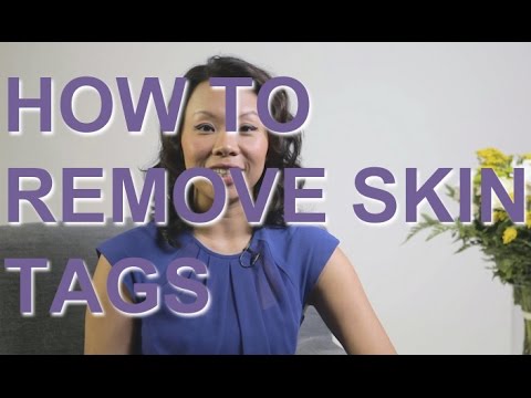 How To Treat Skin Tags At Home