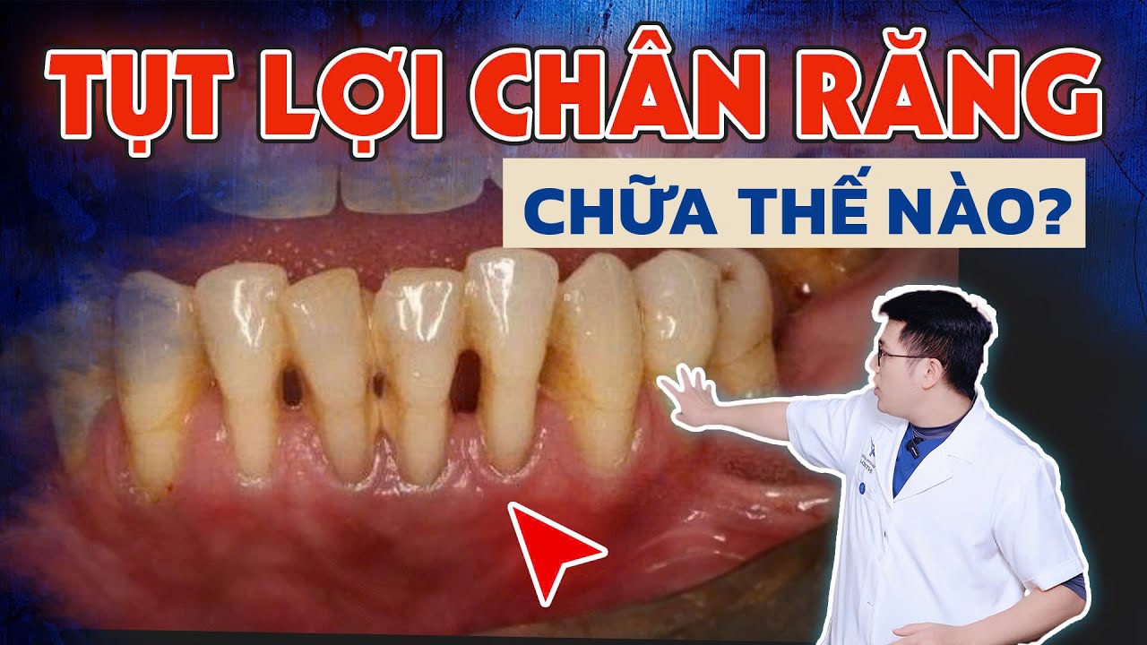 Outline Video Tụt Lợi Có Chữa Được Không? Đừng Bỏ Qua 4 Cách Chữa Tụt Lợi Chân Răng Nhanh Gọn, Đã Được Kiểm Chứng!