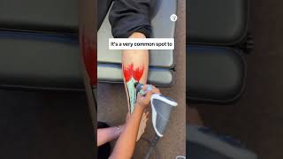 How to treat Achilles Tendonitis