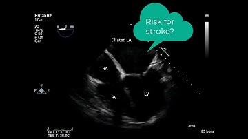 What´s the reason for the stroke? Let
