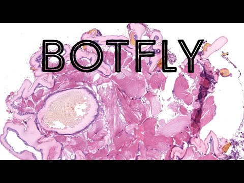 Botfly under the microscope (dermatobia hominis larva skin biopsy) pathology dermatology dermpath