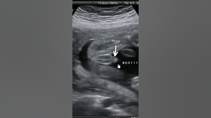 Baby Boy Ultrasound Scan #shorts #Gender #boyorgirl