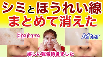 ほうれい線を消す Youtube