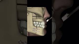 Advanced jaw treatment viralvideo trendingvideo medical science doctor skull digestivesystem
