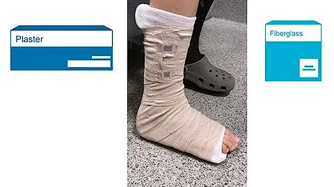 Splinting with fiberglass versus plaster