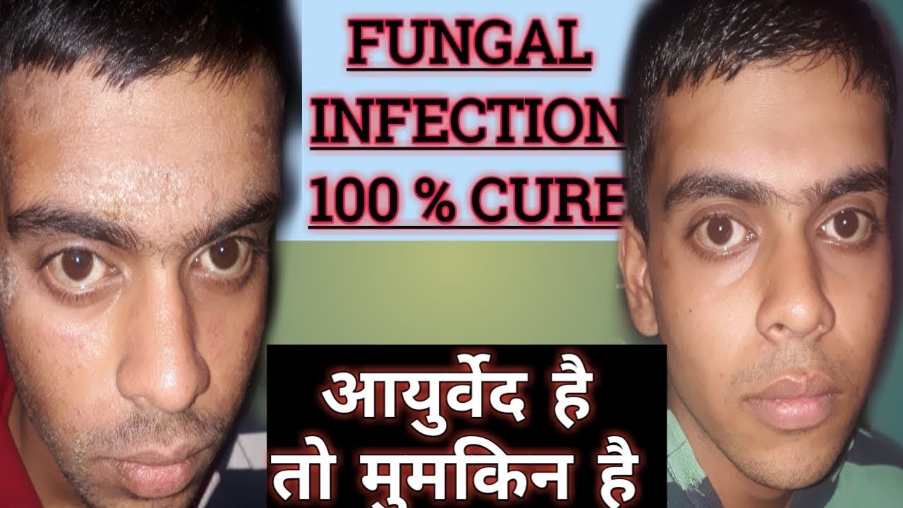 FUNGAL INFECTION ON FACE PERMANENT CURE दादखाजखुजली से परेशान