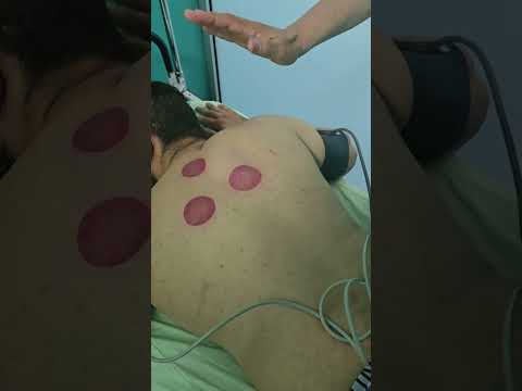 الحجامة بين وضعية الجلوس والاستلقاء