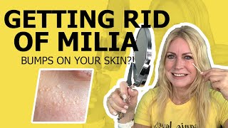 How To Get Rid Of Milia | Hard Bumps On The Skin