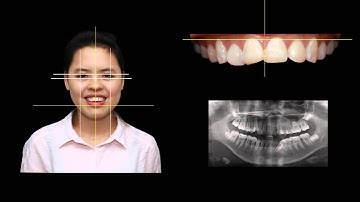 Bọc răng sứ 3D Cad Cam Demo