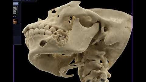 Ameloblastoma with Cinematic Rendering