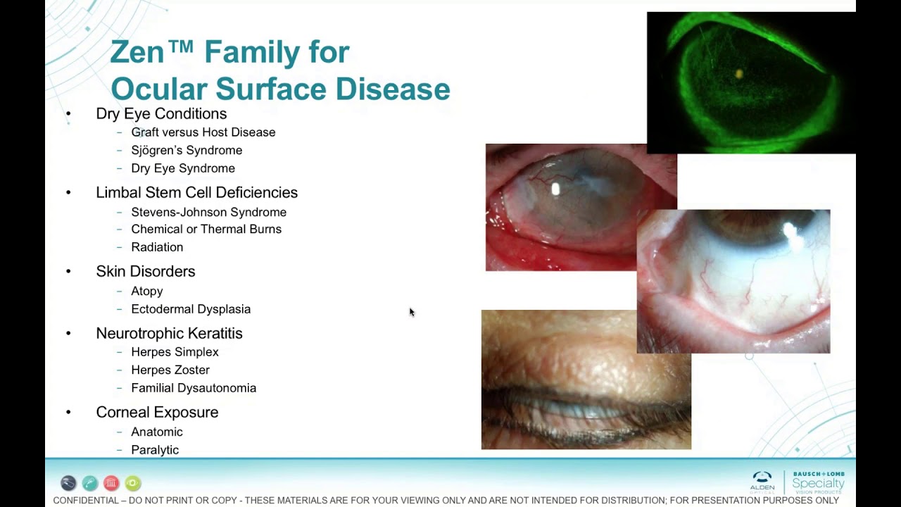 Finding Zen for Ocular Surface Disease