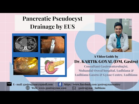 Endoscopic Ultrasound।Pancreatic Pseudocyst Drainage।No Surgery/Incision। Dr. Kartik Goyal।DM Gastro