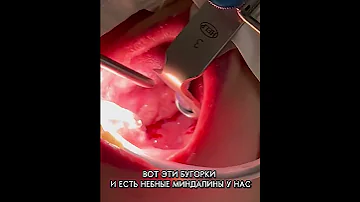 Аденотомия
