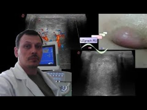 Детское УЗИ мягких тканей - образование крестцовой области у ребенка