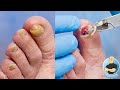 TRIMMING OFF A BLOODY LIFTED TOENAIL WITH NO NUMBING NEEDED!!!