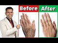 How To Make Your Hands Look 5 Years Younger | Wrinkle Free Smooth Hands - Dr. Vivek Joshi