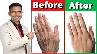 How To Make Your Hands Look 5 Years Younger | Wrinkle Free Smooth Hands - Dr. Vivek Joshi