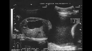 Single Deepest Pocket SDP, Amniotic Fluid Index AFI;  assess amniotic fluid volume