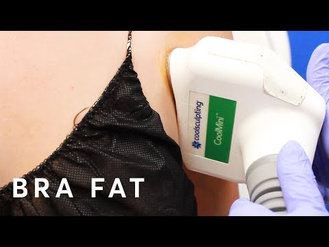 CoolSculpting Fat Freezing Bra Fat