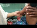 Pulled elbow, reduced | Emrgncy reduction, Pulled elbow | Supersupination method reduction | Adamya