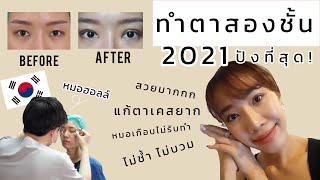 ทำตาสองชั้น แก้ตาเคสยาก [2021] สวยมากกก! ไม่บวม ไม่ช้ำเลยยย | หมอฮอลล์ Goodwill Clinic | JAADULY