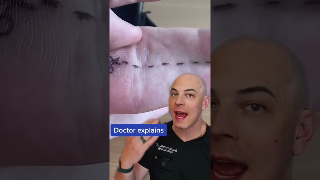 Doctor Explains Fused Fingers Fusedfingers Skin Doctorreacts Dermreacts