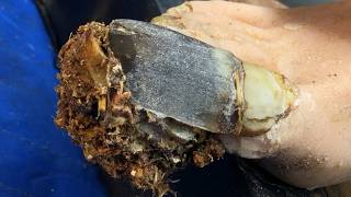 Ingrown toenails with onychomycosis, toenails have fungus black mud 1591