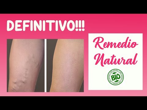Elimina las VARICES para siempre con este REMEDIO 100% NATURAL Elimina las VARICES para siempre con este REMEDIO 100% NATURAL