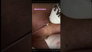 Relax Blackhead Removal 097  shorts  blackhead  acne  pimplesremoval  satisfying