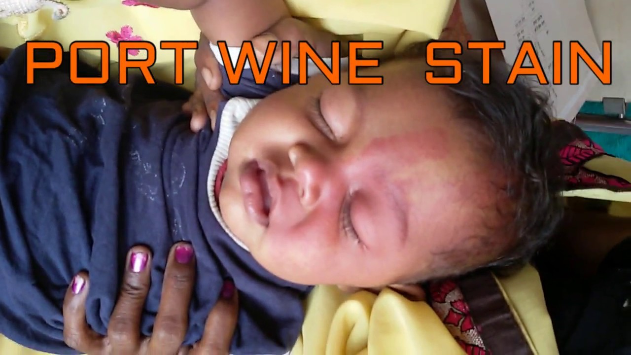 STURGE WEBER SYNDROME YouTube