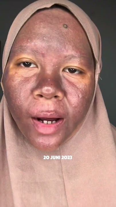 SEMBUH DARI DAMPAK MERKURI ? #journey #skincareroutine #merkuri #skincare #pejuangkulitsehat