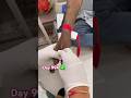 Day 994 ✅ Cannula Insertion #education #nurse #nursingstudent #nursing #bscnursing #ytshorts #gnm