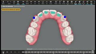 Motivational Invisalign Moderate ClinCheck Simulation | Severe Crowding & Collapsed Occlusion