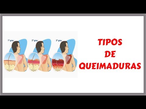 Vídeo: Grau De Queimaduras - 1, 2, 3 E 4 Graus De Queimadura, Sinais E Sintomas