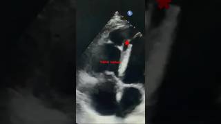 (VSR)-Ventricular septal rupture,post MI ,2D echo