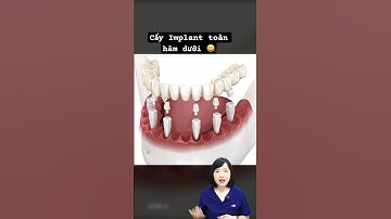 Cấy Implant toàn hàm cho hàm dưới | Dr Anh Thư