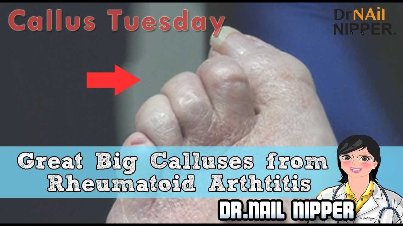 Great Big Calluses from Rheumatoid Arthritis #23 - Callus Tuesday - YouTube