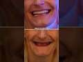 #dentist #smiledesigndental #smile #dentalartistry #atomclinic #smilemakeover #smilemakeoversusa