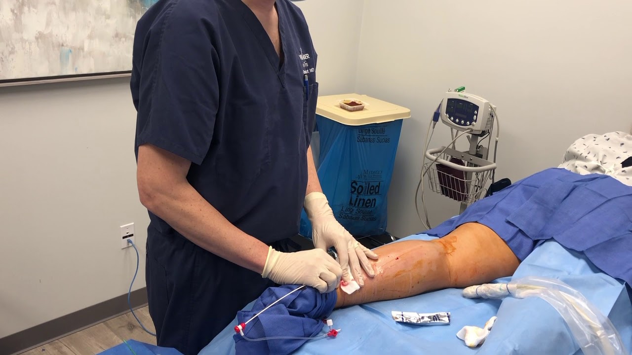 Endovenous Laser Treatment YouTube