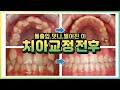 충격! 치아교정되어가는 신기한 전후영상!!!