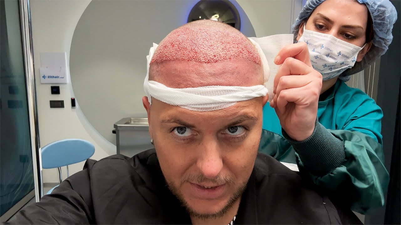 Ich mache meine 5.Haartransplantation in Istanbul 🇹🇷 bei Elithair. ￼