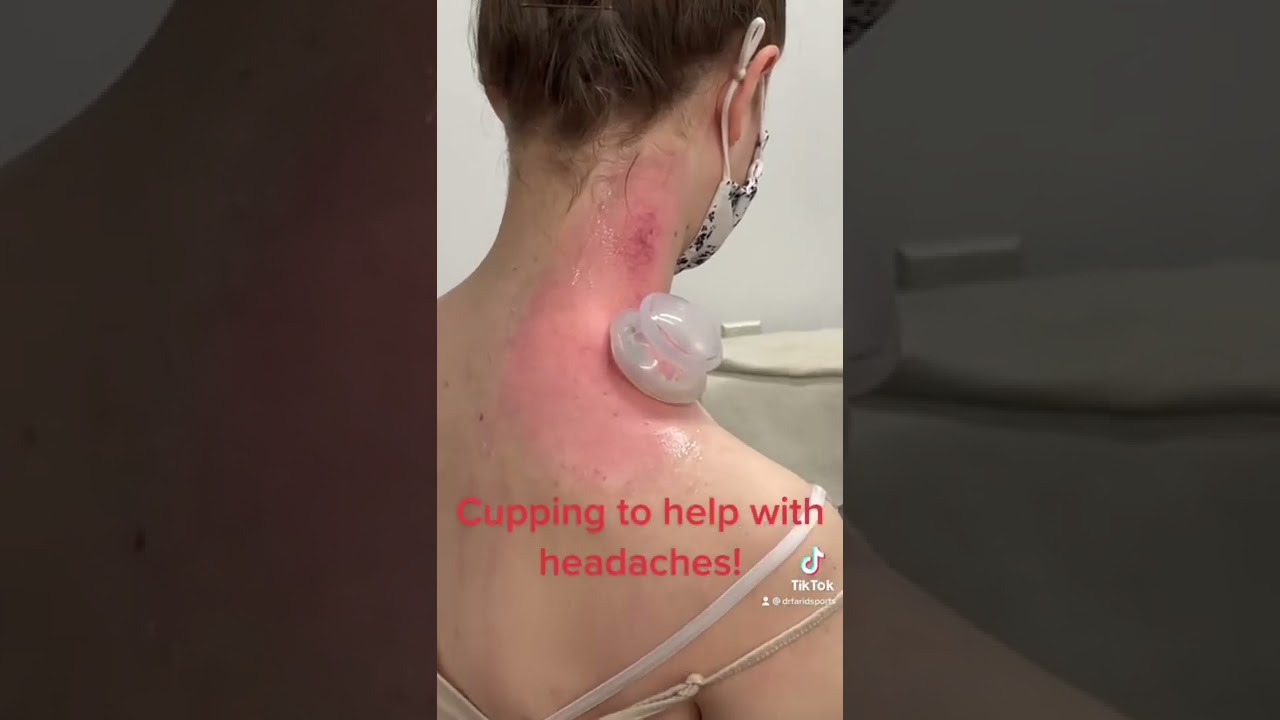 Headache, neck pain, migraine, cupping, chiropractor