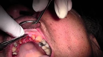 Extraction #9 with GBR Socket Grafting, Atraumatic Extraction