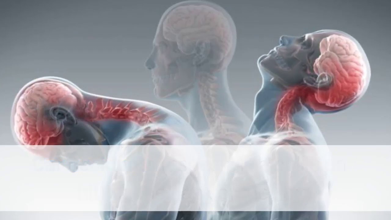 How To Treat Whiplash Naturally At Home 