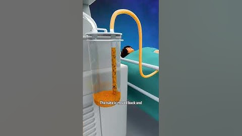 How Liposuction Works: Quick Overview #shorts - creativelearning3d