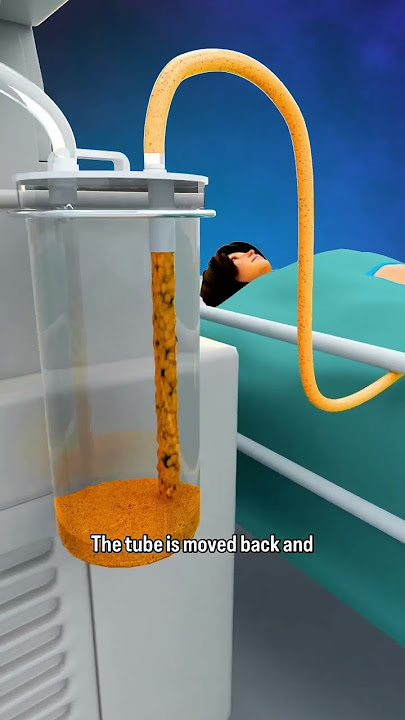 How Liposuction Works: Quick Overview #shorts - creativelearning3d