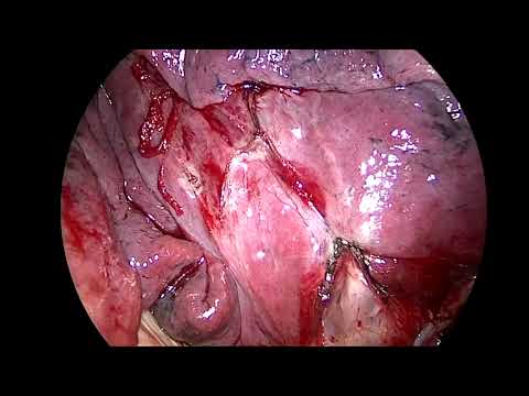 Uniportal VATS Right Upper Lobe Posterior (S2) Segmentectomy - Selcuk Gurz,MD.