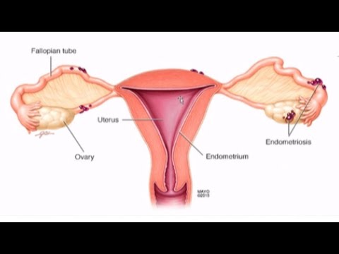 Видео: Защо ендометриумът става дебел?