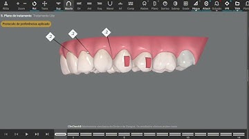 Invisalign clincheck simulation: Space reduction lower arch. Alignemt uper teeth
